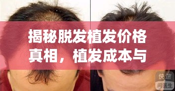 揭秘脫發(fā)植發(fā)價(jià)格真相，植發(fā)成本與最佳方案選擇全解析