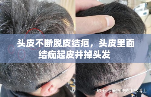 頭皮不斷脫皮結(jié)疤，頭皮里面結(jié)痂起皮并掉頭發(fā) 