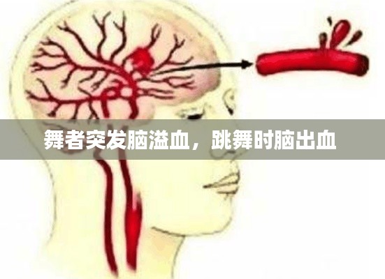 舞者突發(fā)腦溢血，跳舞時腦出血 